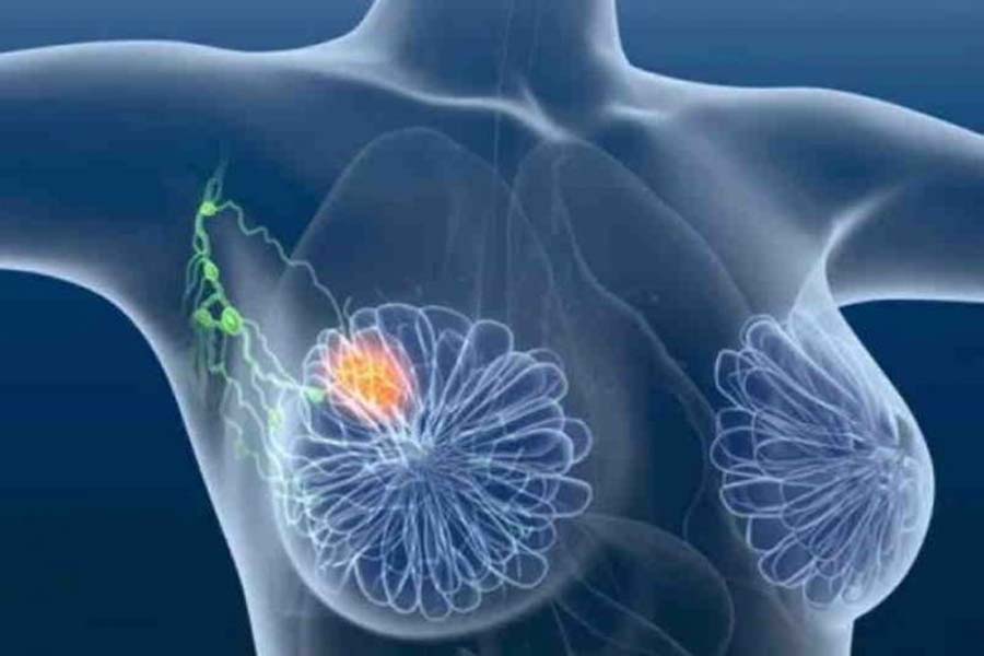 Médicos descobrem novo tratamento para câncer de mama agressivo - News Rondônia