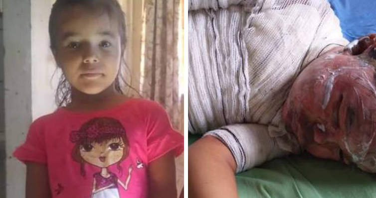 Menina vilhenense de 06 anos tem corpo atingido por fogo durante churrasco e é transferida de avião para Porto Velho - News Rondônia