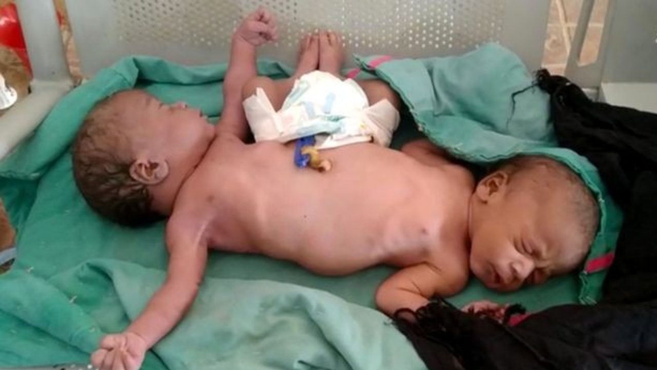IMPRESSIONANTE: Gêmeas siamesas nascem com duas pernas e quatro braços e desafiam médicos - News Rondônia